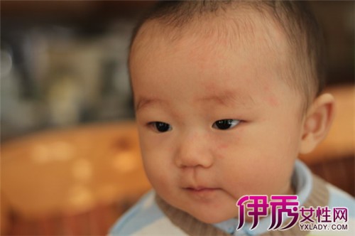 【玫瑰疹】【图】婴儿玫瑰疹有多可怕 如何预