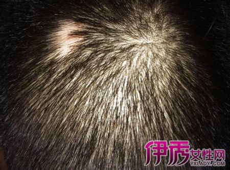 【图】严重掉头发是什么原因揭开女性脱发的6