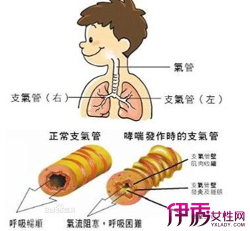 急性支气管炎_急性支气管炎严重