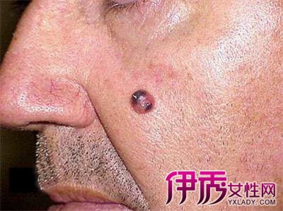 【良性黑色素瘤】【图】良性黑色素瘤揭秘 教