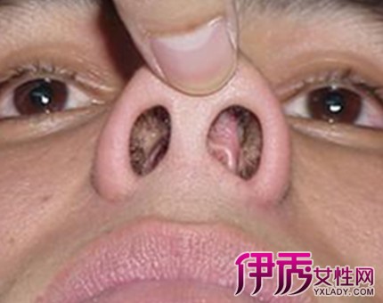 【图】揭秘鼻中隔偏曲的危害 为你分析病因及治疗方法