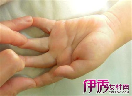 【图】小手指弯曲能矫正吗 屈曲指畸形的治疗方法