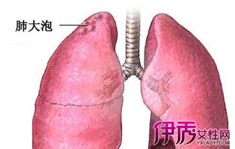 【肺大泡最新治疗方案】【图】肺大泡最新治疗