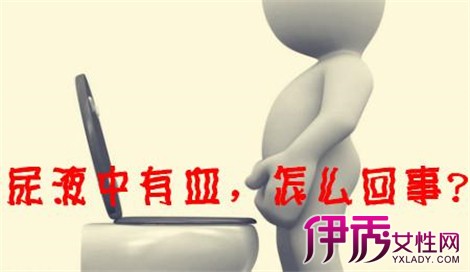 【图】男性不要被小便带血给吓到了 男性尿血相关疾病