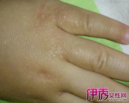 【图】手上长小水泡的危害 汗疱疹是皮肤湿疹