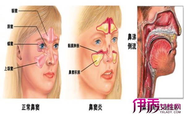 两类鼻炎的检查方法