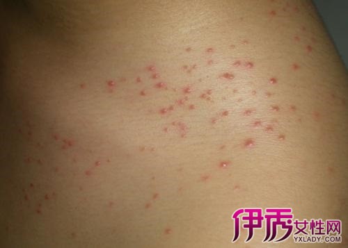 皮疹症状 皮疹是一种皮肤病变.