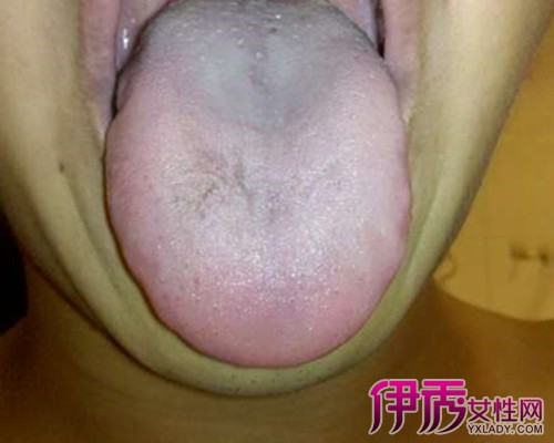 健康 / 正文 在病变和周围的舌头位于领带,皮疹隆起乳头状,菜花状