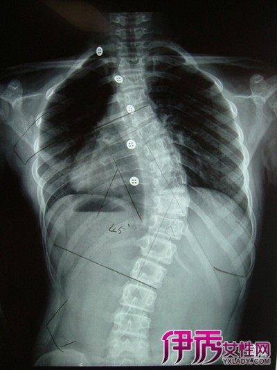 诊断(一)脊柱侧凸的早期诊断…… (1)x线片检查 最为