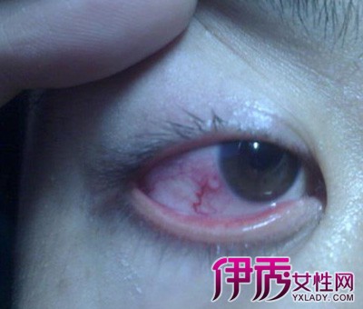 【图】溃疡性角膜炎的症状 眼角发炎要怎么办?