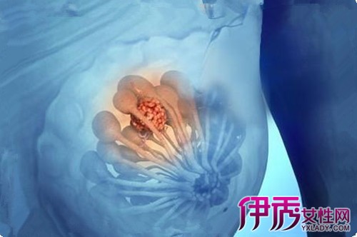 【乳房肿块的鉴别诊断】【图】健康窍门乳房肿