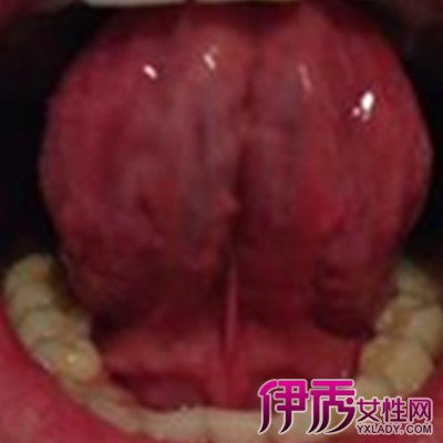 【图 舌根部淋巴滤泡增生的治疗方法 让你远离病痛折磨