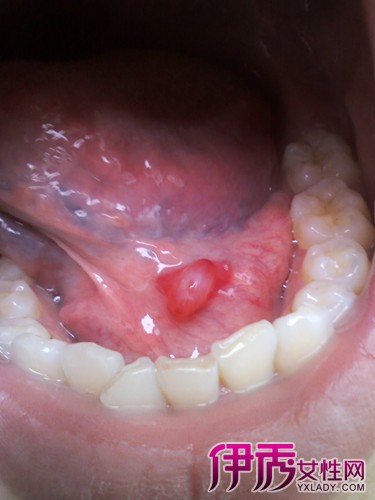 【图】舌头长泡是什么原因 治疗舌头上的小水泡只要三招