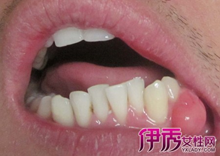 伊秀生活网 健康 正文 牙龈瘤是牙龈上特别是龈乳头处局限生长的炎