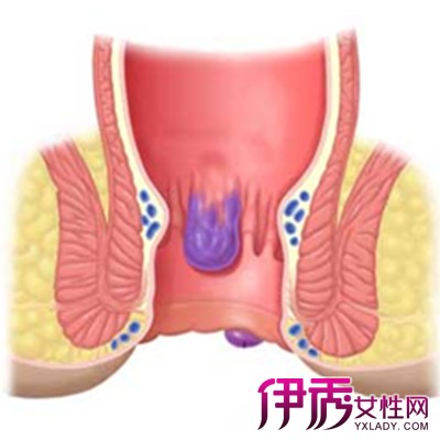 【痔疮会导致便秘吗】【图】请问痔疮会导致便