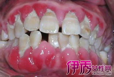 【图】牙龈脓肿图片 患者的治疗方法与预防