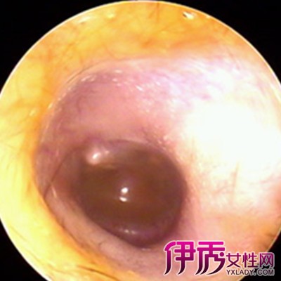 【图】耳朵中耳炎病因是什么 4个治疗方法尽早康复