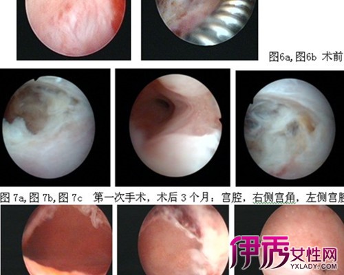 健康 正文  宫腔粘连能治好吗  宫腔粘连可以有效的方法是通过手术