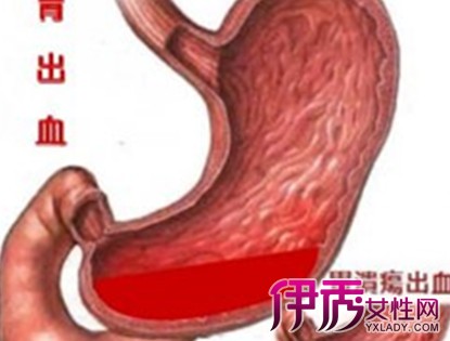 【图】胃出血吃什么药好得快 3种治疗让你胃健康