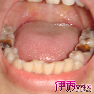 【图】智齿蛀牙怎么治疗 6点预防小建议随时注意