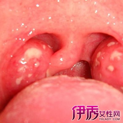 患急性传染病(如猩红热,麻疹,流感,白喉等)后可引起慢性扁桃体炎,鼻腔