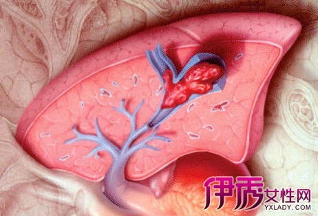 【肺腺癌晚期能活多久】【图】肺腺癌晚期能活