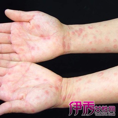 【图】二期梅毒多久能治愈呢 常见的皮肤损害有哪些