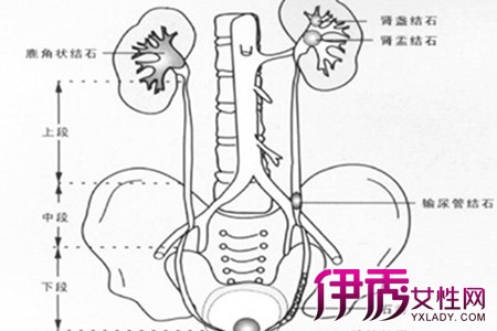 【图】输尿管结石排出图片 它的危害是什么