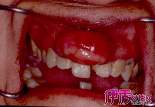 【牙龈瘤初期图片】【图】牙龈瘤初期图片展示