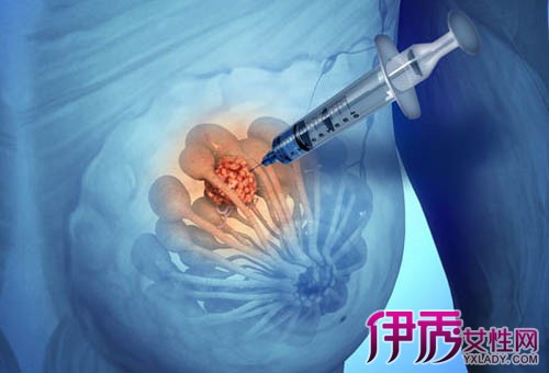 【图】乳腺癌晚期死前征兆有哪些? 4大临床征兆告诉你