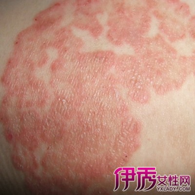 【图】湿疹的图片大全欣赏 告诉你3种有效治疗湿疹的办法