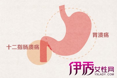 【什么是胃溃疡】【图】什么是胃溃疡? 4种症