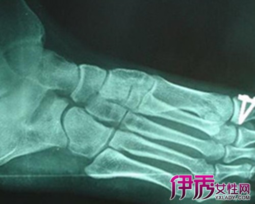 【跖骨趾骨骨折】【图】跖骨趾骨骨折的病理原