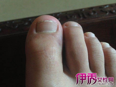 【图】脚指甲盖发紫就怎么回事 是哪些病因引起的?