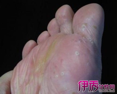 【图】水泡型脚气图片展现 分析此病的临床表现及症状