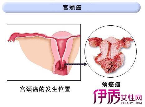 【宫颈癌原因】【图】女性患宫颈癌原因 患宫
