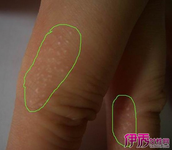 【图】手指真菌感染症状是什么 3大治疗手指真菌感染的方法