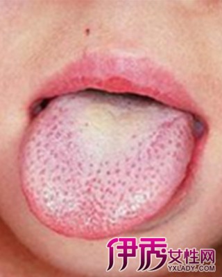 【图】问草莓舌头是什么病 其症状都有哪些?