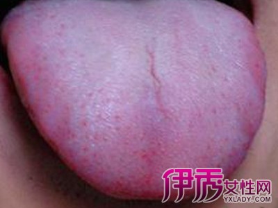 感染者的舌头有哪些症状 大部分患者通过性传