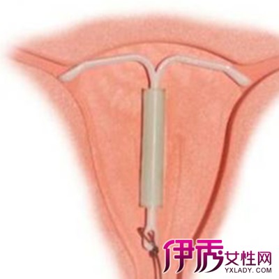 上环后月经不正常 在一般的情况下,女性上环的最近时期应在月经干净后