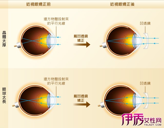 起来了解各种近视矫正的方法……  每个人都希望拥有一双明亮的大眼睛