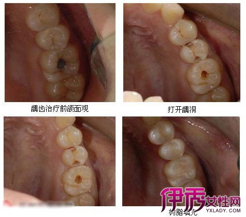 【图】补牙洞过程图解及方法 小牙不补大牙吃苦