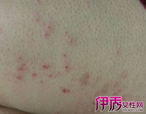 【大腿内侧痒是怎么回事】【图】大腿内侧痒是