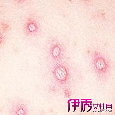 【图】水痘的症状和治疗图片大全 如何预防和
