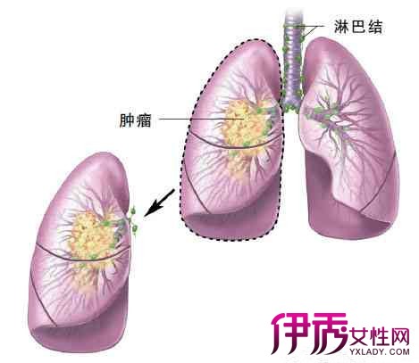 【小细胞肺癌脑部转移】【图】什么是小细胞肺