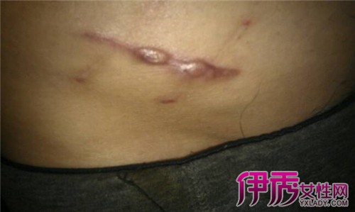 【图】阑尾炎手术疤痕图片 3种疗法让你摆脱炎症