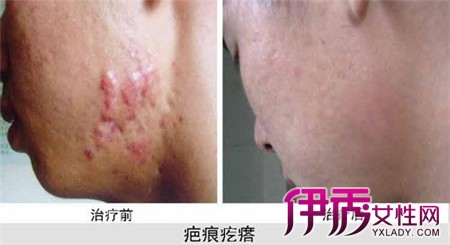 【增生性瘢痕】【图】增生性瘢痕是什么 怎么