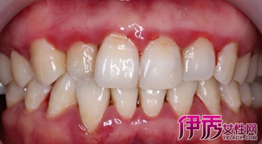【图】牙周炎早期图片集锦 治疗牙周炎的方法有哪些?