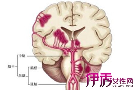 小脑出血与高血压病有直接关系,是由小脑齿状核动脉破搜所致.