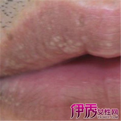 【图】嘴唇皮脂腺异位症 皮脂腺的发育与性激素有关